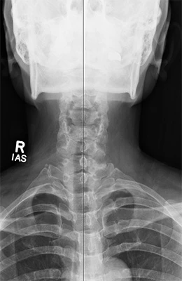 Chiropractic Redondo Beach CA Headache X Ray