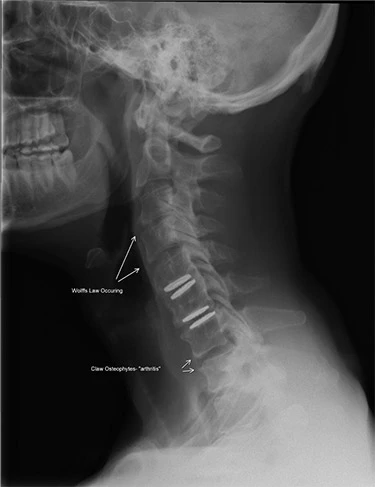 Chiropractic Redondo Beach CA Lateral Nerve X Ray