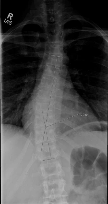 Chiropractic Redondo Beach CA Scoliosis X Ray