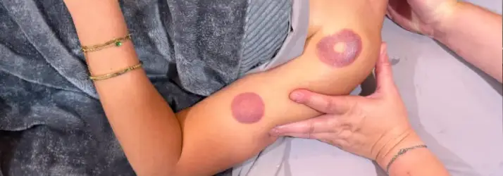 Chiropractic Redondo Beach CA Cupping For Massage Therapy