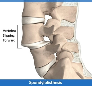 Chiropractic Redondo Beach CA Spondylolisthesis Vertebra