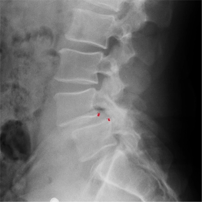 Chiropractic-Redondo-Beach-CA-Spondylolisthesis-X-Ray